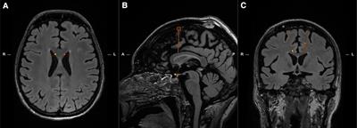 Case report: MR-guided laser induced thermal therapy for palliative cingulotomy